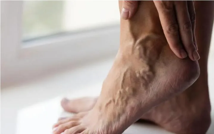 A bare foot and ankle seen side-on, with raised veins visible across the instep