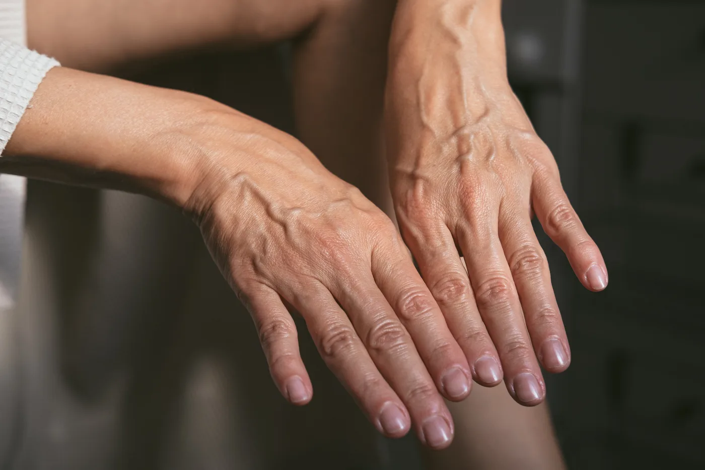Both hands of an older adult resting one across the other, backs upward, with prominent branching veins raised across the back of the hand and along the wrist