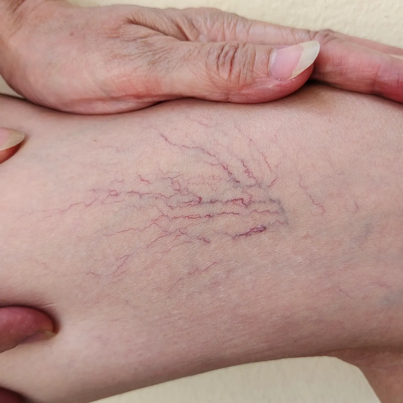 A close view of a thigh held between two hands, with a fan of fine red and purple spider veins branching across the skin