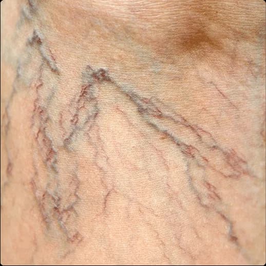 Close-up of skin behind the knee showing a dense, fanned network of fine red and blue spider veins