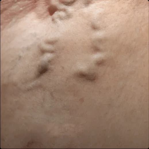 Close-up of pale leg skin with a chain of raised, knotted varicose veins running across it