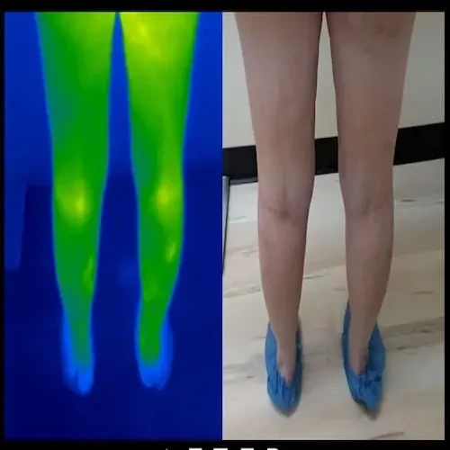 Después del tratamiento: la parte posterior de ambas piernas junto a una imagen térmica verde; la piel se ve más suave y uniforme.