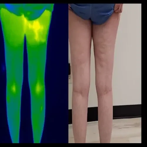 Antes del tratamiento: la parte posterior de ambas piernas junto a una imagen térmica verde y azul; se ven venas y textura irregular en los muslos y las pantorrillas.