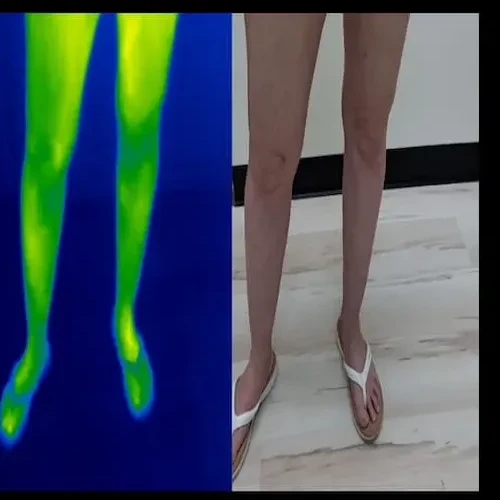 Después del tratamiento: vista frontal de las mismas piernas junto a una imagen térmica verde más uniforme; la piel se ve más clara, con las venas y manchas muy reducidas.