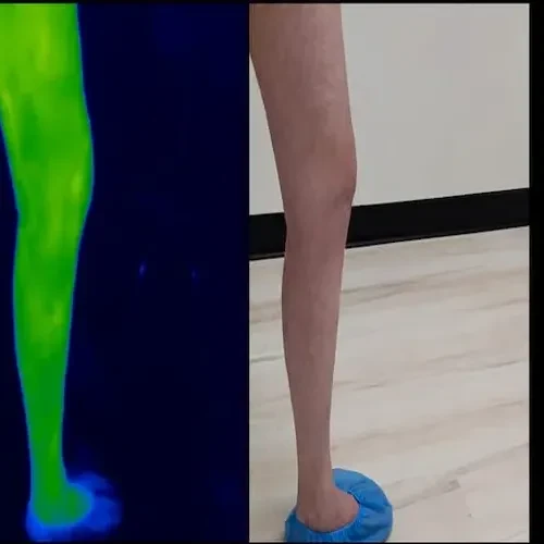 Después del tratamiento: la cara interna de la misma pierna izquierda junto a una imagen térmica verde y azul; la piel se ve más clara.