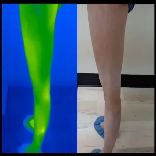 Después del tratamiento: la cara externa de la misma pierna izquierda junto a una imagen térmica verde; la piel se ve más clara y uniforme.