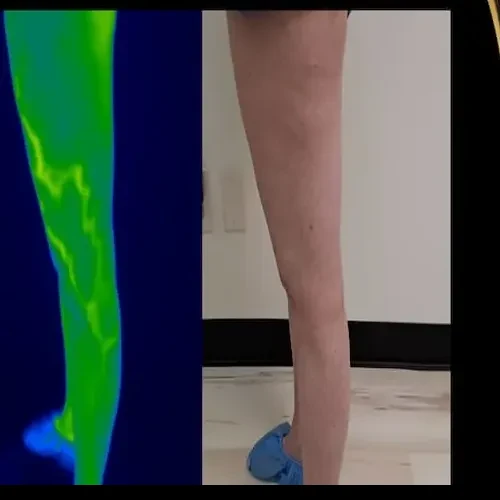 Antes del tratamiento: la cara externa de una pierna izquierda junto a una imagen térmica verde con una franja cálida; se ven arañas vasculares y pequeñas manchas en la pantorrilla.