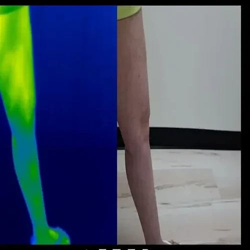 Después del tratamiento: la misma pierna izquierda junto a una imagen térmica mayormente azul; la piel se ve más clara y uniforme.