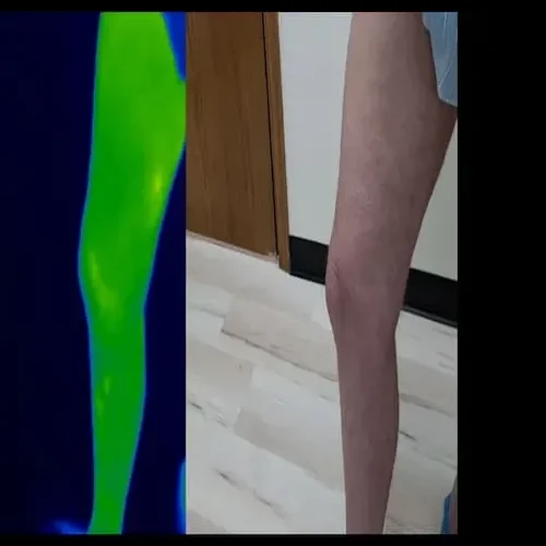 Después del tratamiento: la cara interna de una pierna derecha junto a una imagen térmica verde más fría; la piel se ve más clara y uniforme.