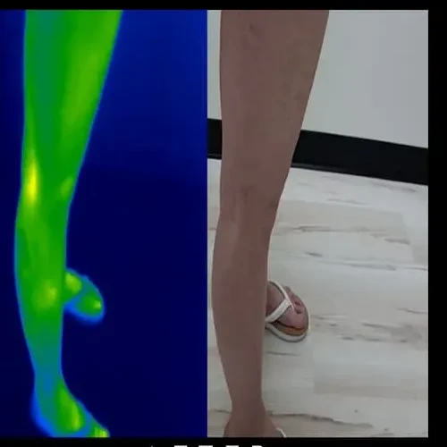 Después del tratamiento: la misma pierna derecha junto a una imagen térmica verde; la pantorrilla se ve más suave con las venas reducidas.