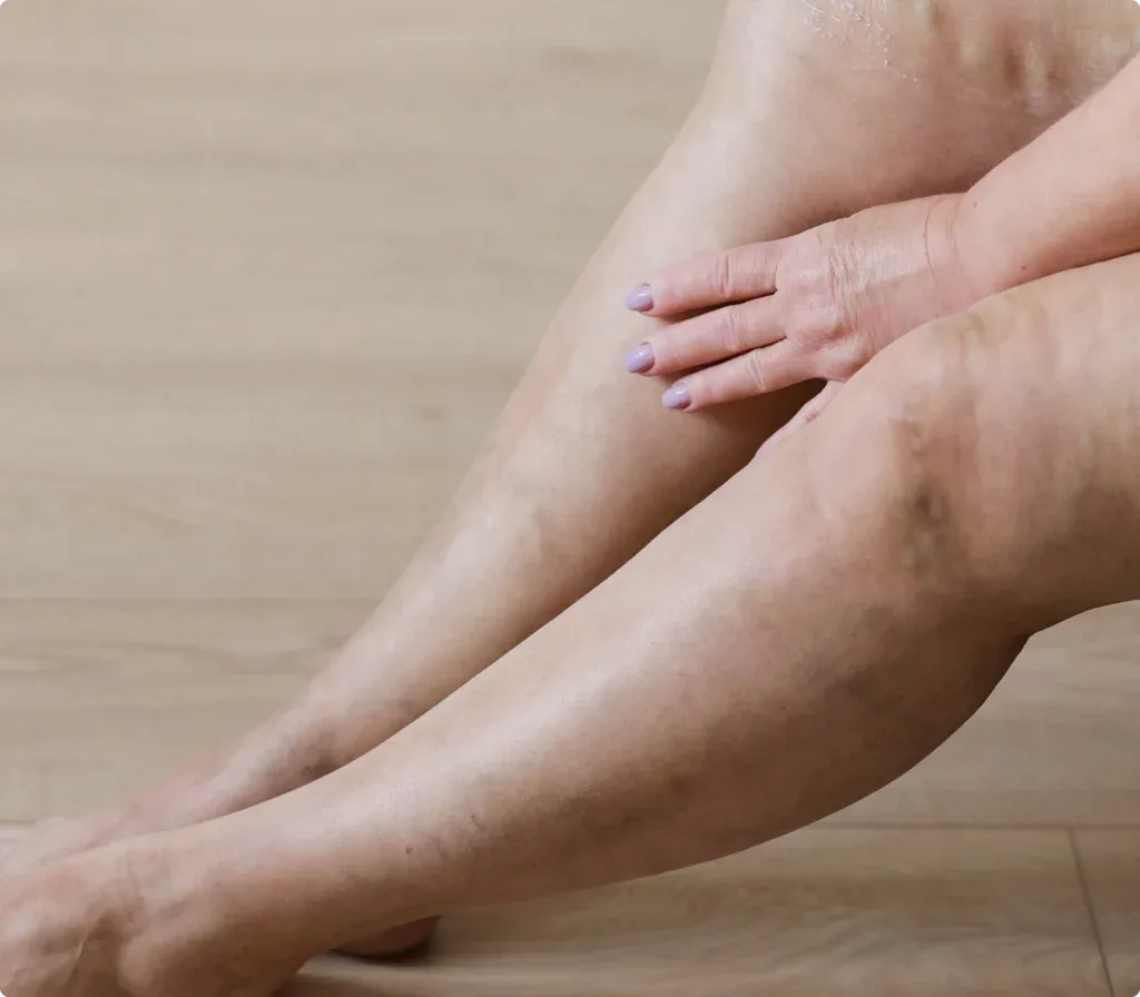 A seated person's bare lower legs, one hand resting on the calf, with darkened veins visible around the ankle and along the shin.
