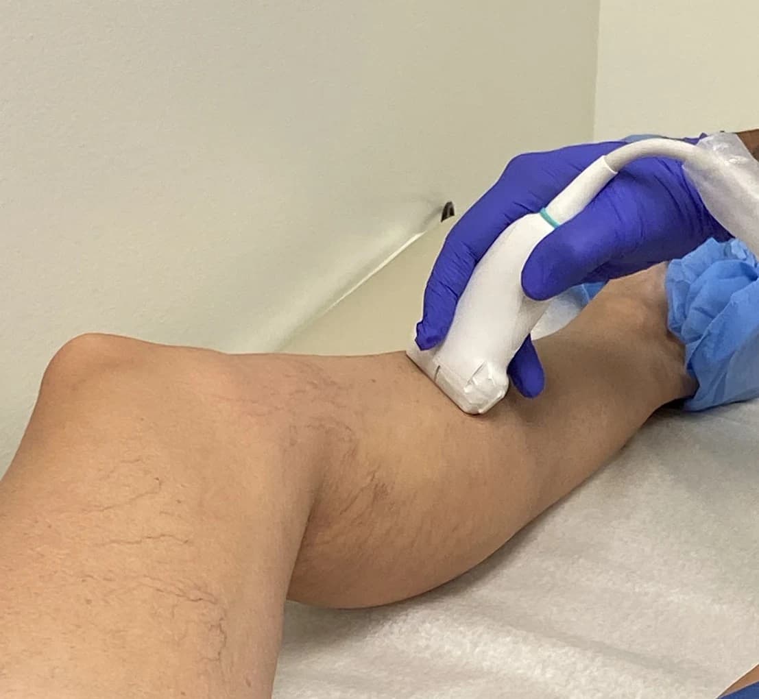 Close-up of a gloved hand pressing a sheathed ultrasound probe against the back of a bare calf, with fine surface veins visible across the skin.