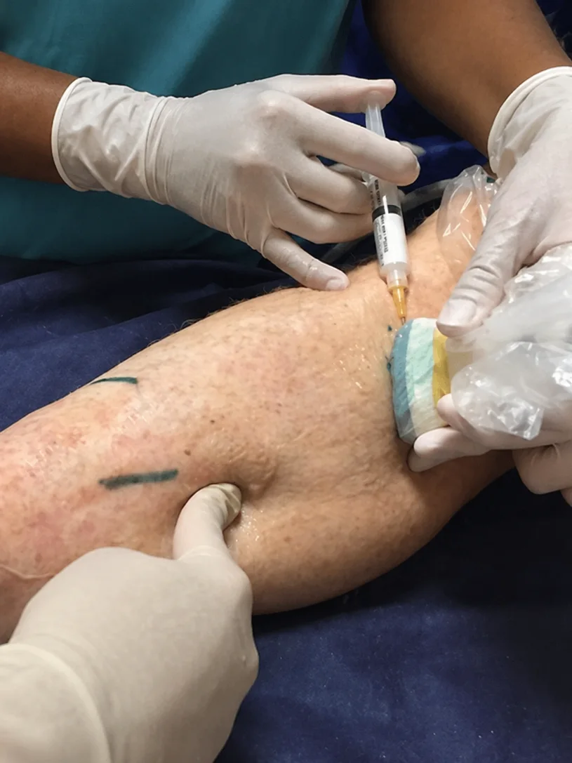 Gloved hands injecting a leg vein with a syringe while an ultrasound probe, wrapped in a clear sterile sleeve, is held against the skin beside the injection site. Surgical marker lines are drawn on the leg.
