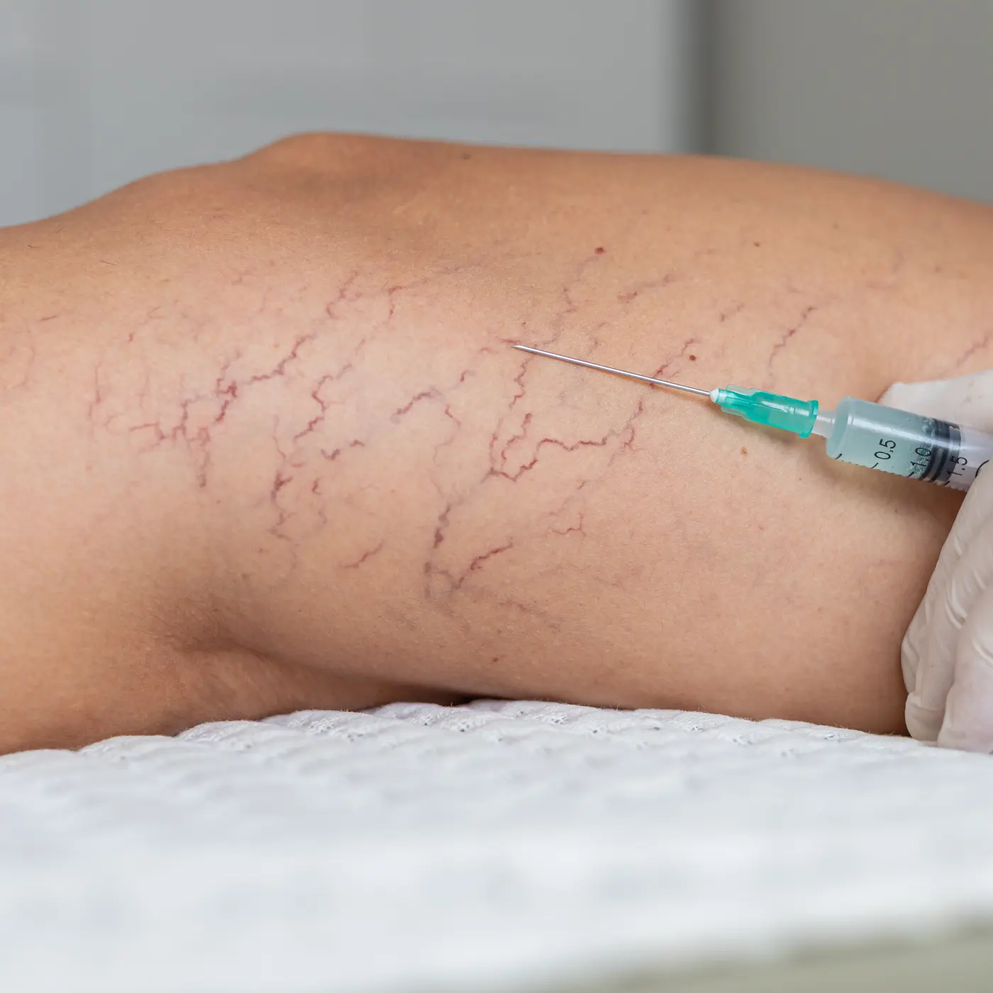A gloved hand holding a fine syringe against the back of a leg covered in spider veins, the needle resting at the skin