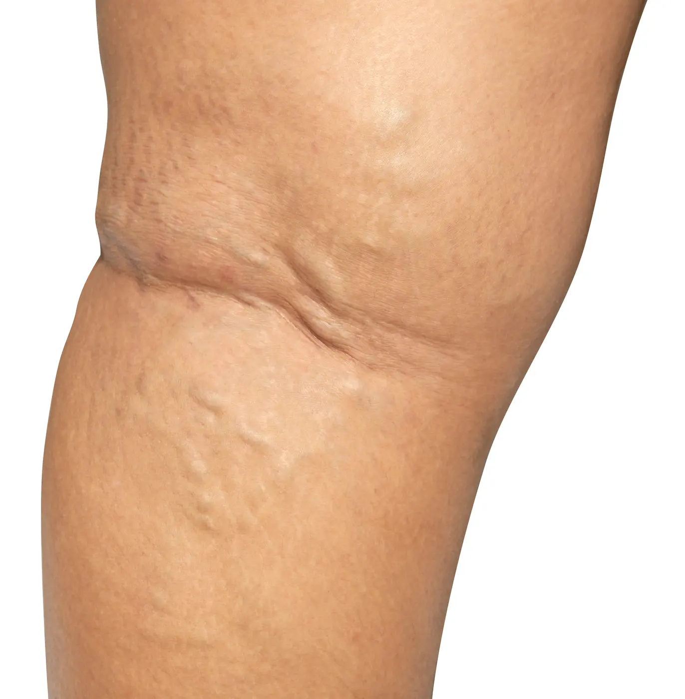 A bare lower leg against a white background, with thick varicose veins raised in ropey ridges behind the knee and down the calf