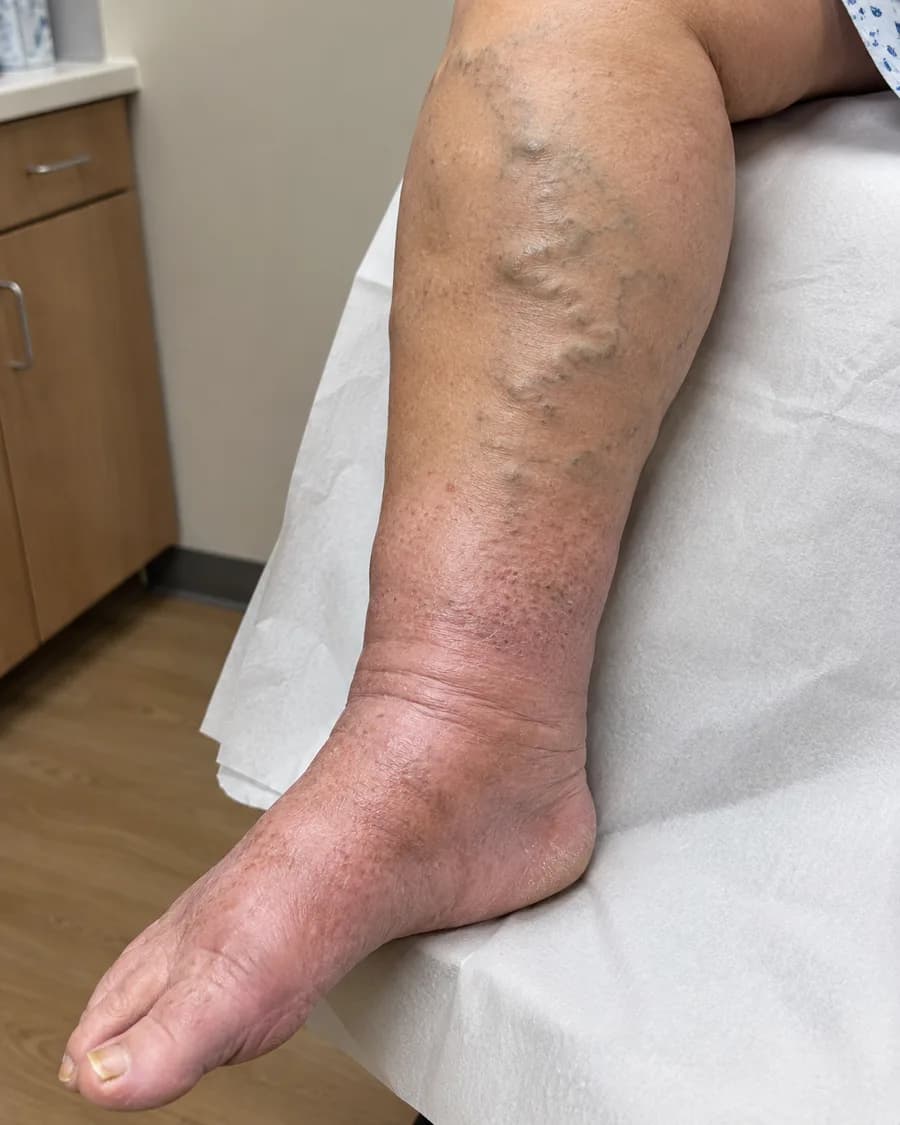 A swollen lower leg, ankle and foot on a paper-covered examination bench, with ropey varicose veins down the calf and darkened skin around the ankle