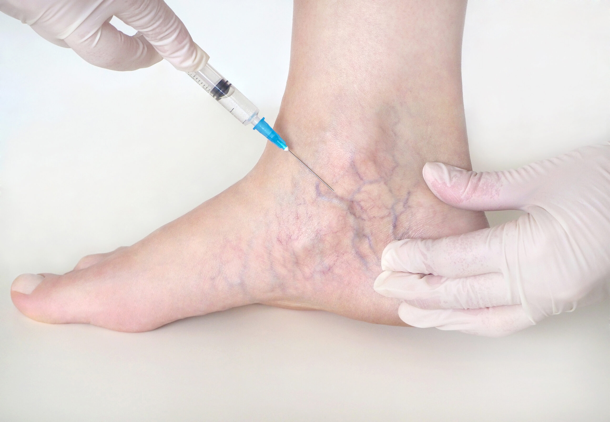 Patient receiving sclerotherapy treatment for the spider veins in her foot and ankle
