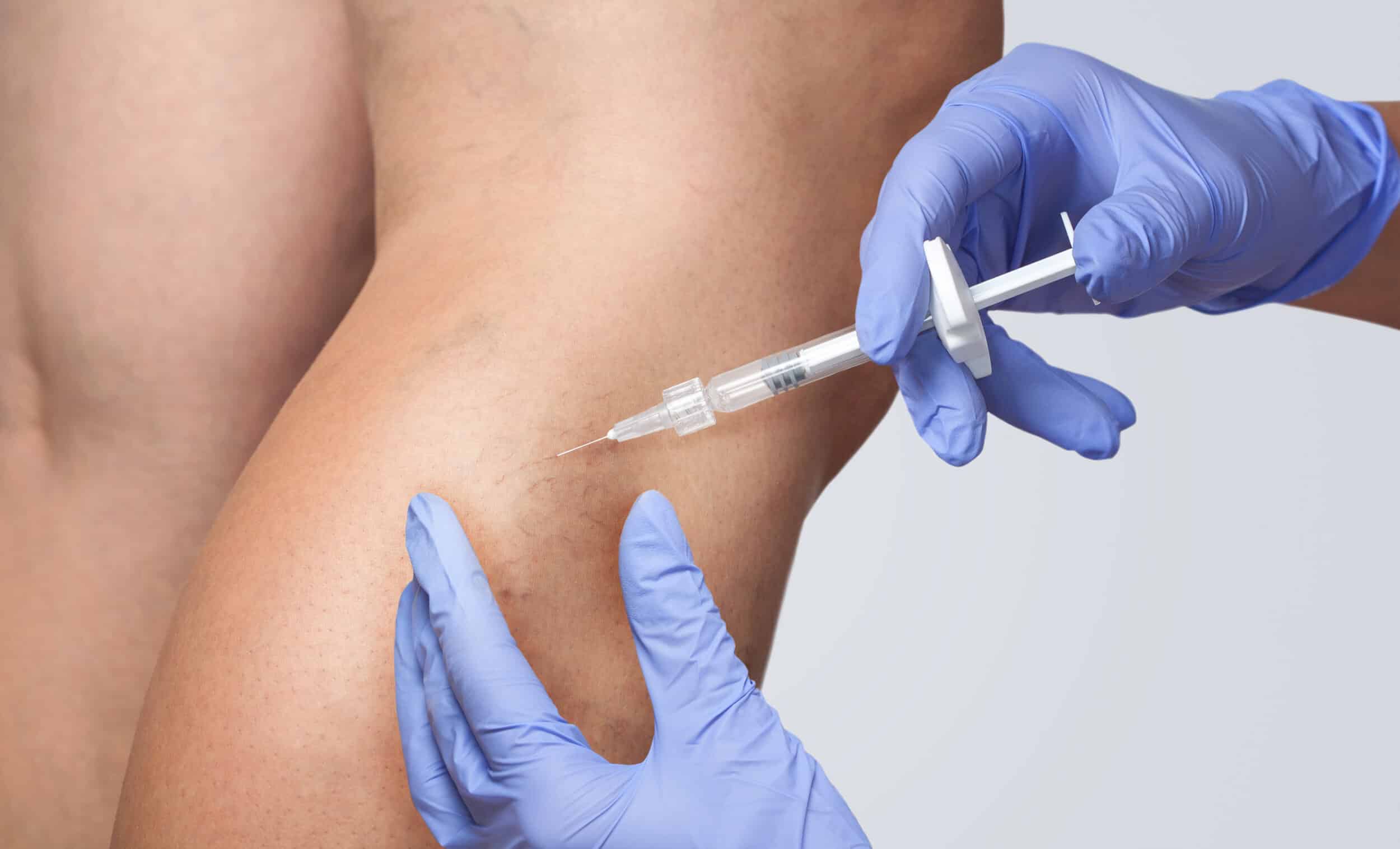 Close up of doctor treating the spider veins on a patient's thighs with sclerotherapy.